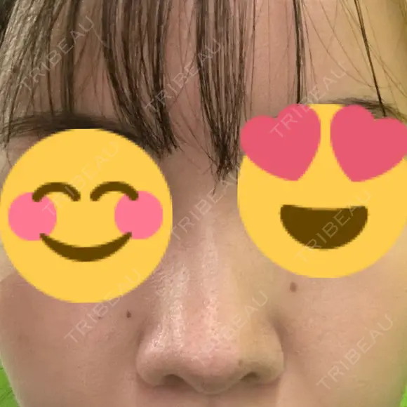 鼻中隔延長（切開） / 鼻尖縮小 ビスポーククリニック 福岡院 DAY 601 メイン用