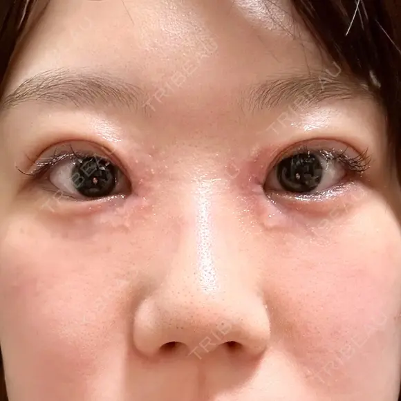 二重埋没 / 目頭切開 Olino美容外科・美容皮膚科 DAY 8 メイン用