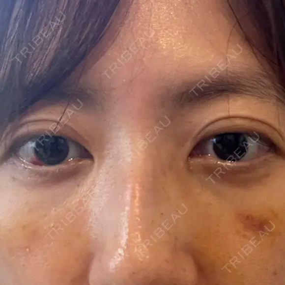 下まぶたの脂肪取り APOLLO BEAUTY CLINIC DAY 10 メイン用