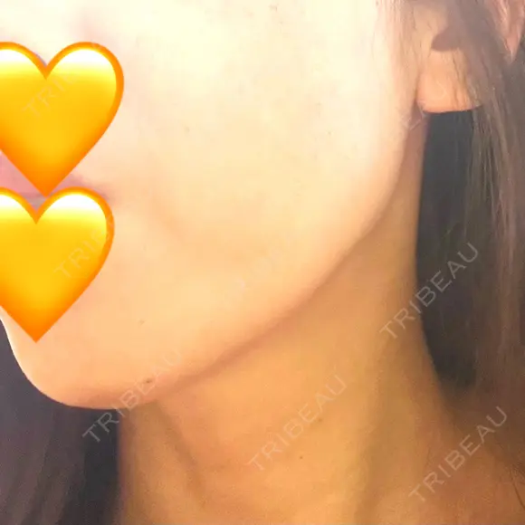 糸リフト アリエル美容クリニック 郡山院 DAY 39 メイン用