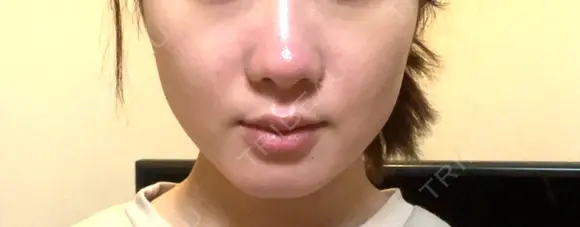 ボトックス（エラ・小顔） ルラ美容クリニック 札幌本院 DAY 0 メイン用