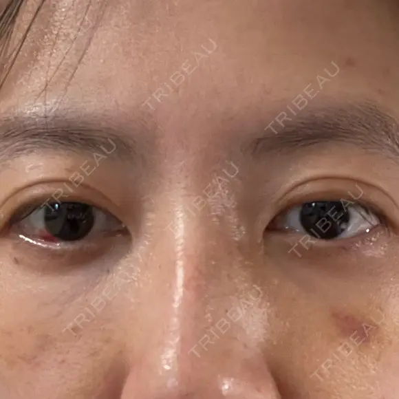 下まぶたの脂肪取り APOLLO BEAUTY CLINIC DAY 11 メイン用