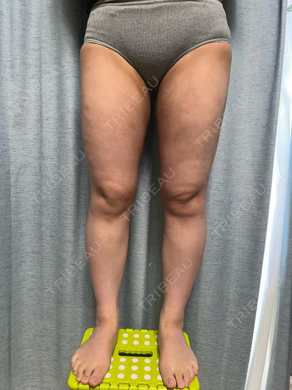 脂肪吸引（脚） / 脂肪吸引（お尻） 湘南美容クリニック 京都院 DAY 30 メイン用