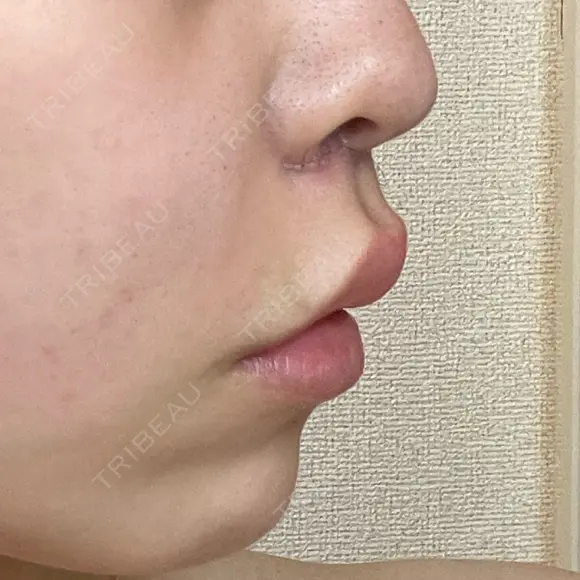 人中短縮 / ボトックス（人中） eクリニック 金沢本院 DAY 3 メイン用