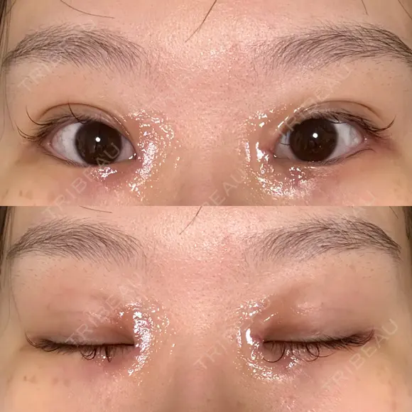 二重埋没 / 目頭切開 Olino美容外科・美容皮膚科 DAY 10 メイン用
