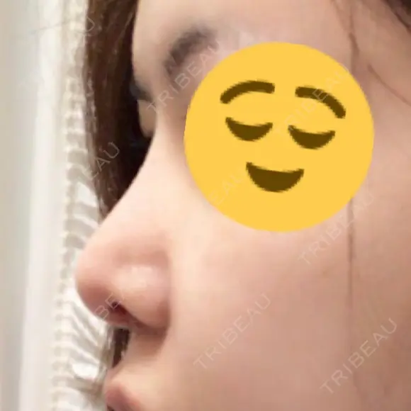 鼻尖形成（切開） / 軟骨移植 / 骨切幅寄せ / 鼻修正 / その他（鼻） 表参道スキンクリニック 表参道院 DAY 27 メイン用