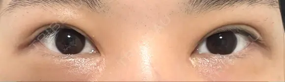 二重切開 / 目頭切開 / 上まぶたたるみ取り 湘南美容クリニック 大阪堺東院 DAY 131 メイン用