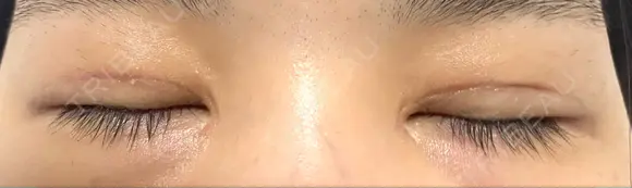 二重切開 / 目頭切開 / 上まぶたたるみ取り 湘南美容クリニック 大阪堺東院 DAY 131 メイン用