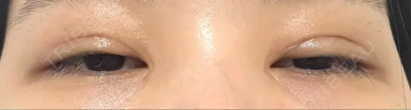 二重切開 / 目頭切開 / 上まぶたたるみ取り 湘南美容クリニック 大阪堺東院 DAY 131 メイン用