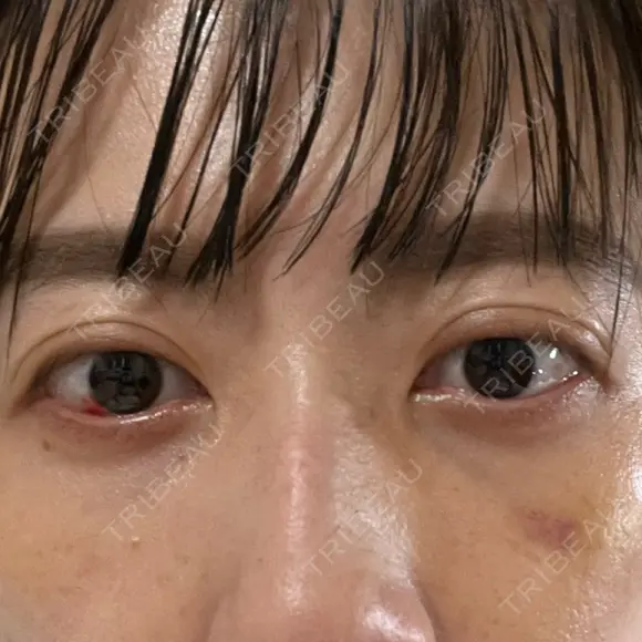下まぶたの脂肪取り APOLLO BEAUTY CLINIC DAY 12 メイン用