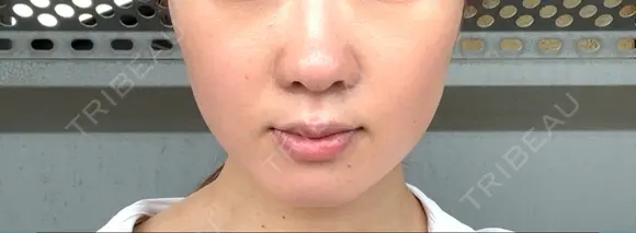 ボトックス（エラ・小顔） ルラ美容クリニック 札幌本院 DAY 2 メイン用