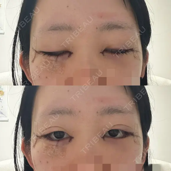 目頭切開 / クマ治療 / 目尻切開 / 下まぶたの脂肪取り / タレ目形成・グラマラスライン（切開） / タレ目形成・グラマラスライン（埋没） / ヒアルロン酸注入（涙袋） / ボトックス（エラ・小顔） Tokyo Tensei Clinic 銀座院 DAY 1 メイン用