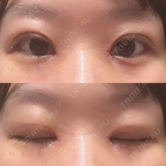 二重埋没 / 目頭切開 Olino美容外科・美容皮膚科 AFTER メイン用