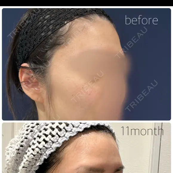 脂肪注入（額） S.T styleクリニック DAY 333 メイン用