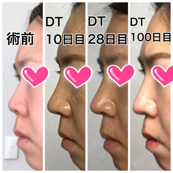 隆鼻術 / 鼻尖形成（切開） / 鼻中隔延長（切開） / 小鼻縮小（切開） ザ・プラス美容外科 DAY 149 メイン用