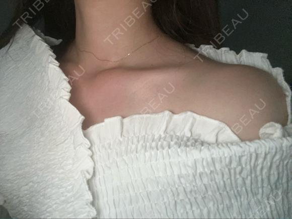 ボトックス（肩） 目白ホワイトクリニック AFTER メイン用
