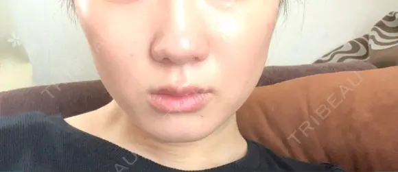 ボトックス（エラ・小顔） ルラ美容クリニック 札幌本院 DAY 3 メイン用