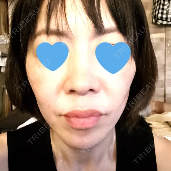 ボトックス（あご） / ボトックス（口角） / ボトックス（眉間） / ボトックス（目尻） / ボトックス（額） / ボトックス（人中） DMTC美容皮膚科 大宮院 DAY 8 メイン用