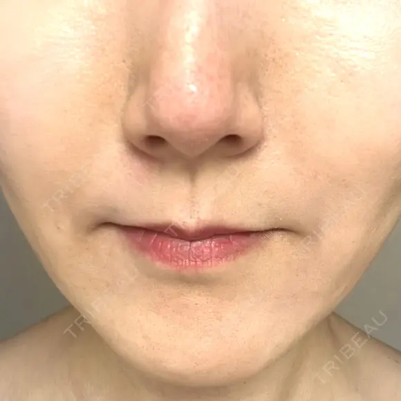 ボトックス（あご） / ヒアルロン酸注入（鼻翼基部） / その他（口元） ルラ美容クリニック 東京駅前院 DAY 9 メイン用