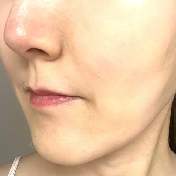 ボトックス（あご） / ヒアルロン酸注入（鼻翼基部） / その他（口元） ルラ美容クリニック 東京駅前院 DAY 9 メイン用