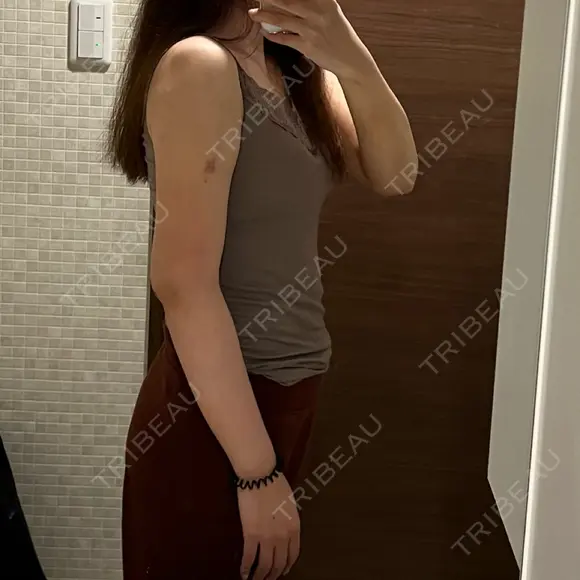 脂肪吸引（二の腕） 湘南美容クリニック 京都院 DAY 11 メイン用