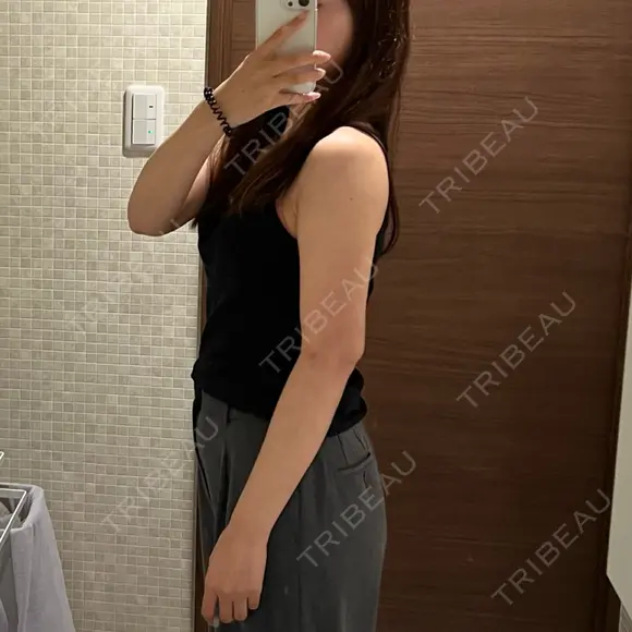 脂肪吸引（二の腕） 湘南美容クリニック 京都院 DAY 18 メイン用