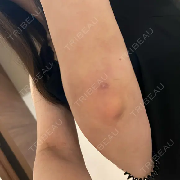 脂肪吸引（二の腕） 湘南美容クリニック 京都院 DAY 26 メイン用