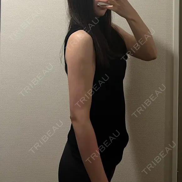 脂肪吸引（二の腕） 湘南美容クリニック 京都院 DAY 34 メイン用