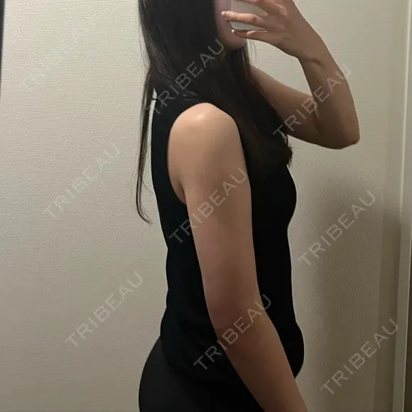 脂肪吸引（二の腕） 湘南美容クリニック 京都院 DAY 34 メイン用