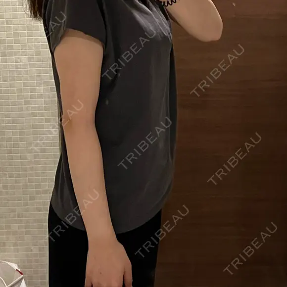 脂肪吸引（二の腕） 湘南美容クリニック 京都院 AFTER メイン用