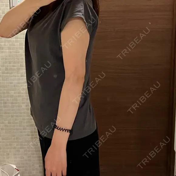 脂肪吸引（二の腕） 湘南美容クリニック 京都院 DAY 95 メイン用