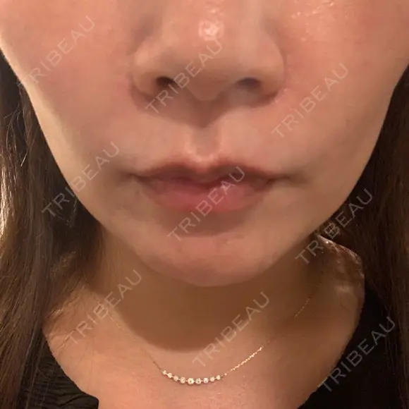 ヒアルロン酸注入（頬） 渋谷美容外科クリニック 渋谷院 AFTER メイン用