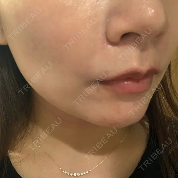 ヒアルロン酸注入（頬） 渋谷美容外科クリニック 渋谷院 DAY 6 メイン用