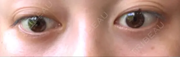 下まぶたの脂肪取り APOLLO BEAUTY CLINIC DAY 20 メイン用