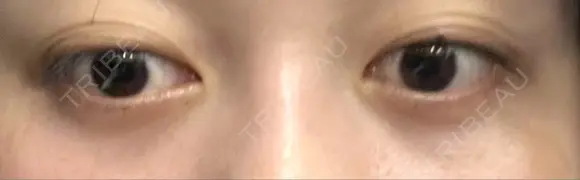 下まぶたの脂肪取り APOLLO BEAUTY CLINIC DAY 21 メイン用