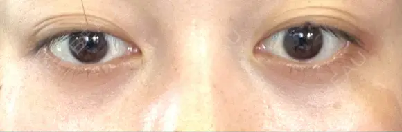 下まぶたの脂肪取り APOLLO BEAUTY CLINIC DAY 22 メイン用