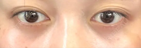 下まぶたの脂肪取り APOLLO BEAUTY CLINIC DAY 23 メイン用