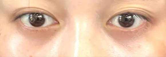 下まぶたの脂肪取り APOLLO BEAUTY CLINIC DAY 24 メイン用