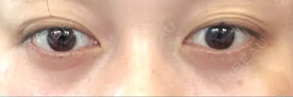 下まぶたの脂肪取り APOLLO BEAUTY CLINIC DAY 24 メイン用
