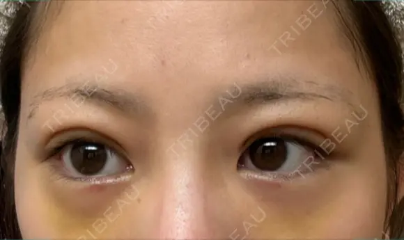 下まぶたの脂肪取り APOLLO BEAUTY CLINIC DAY 6 メイン用