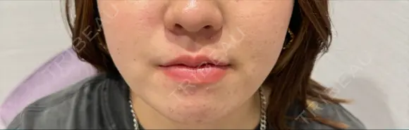 糸リフト / 脂肪吸引（顔） / ヒアルロン酸注入（あご） / ボトックス（エラ・小顔） R Beauty CLINIC 名古屋院 DAY 34 メイン用