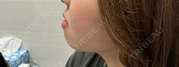 糸リフト / 脂肪吸引（顔） / ヒアルロン酸注入（あご） / ボトックス（エラ・小顔） R Beauty CLINIC 名古屋院 DAY 34 メイン用