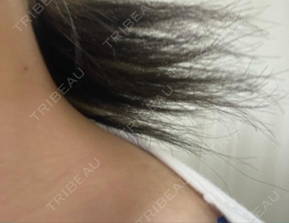 ボトックス（肩） DMTC美容皮膚科 大宮院 AFTER メイン用