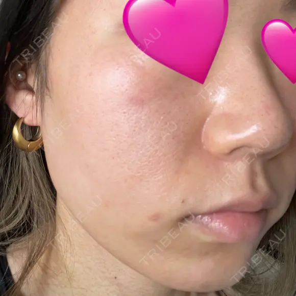 医療痩身（顔） 渋谷美容外科クリニック 横浜院 AFTER メイン用