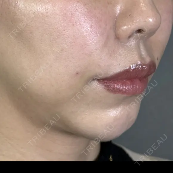 ヒアルロン酸注入（頬） アリエル美容クリニック 郡山院 AFTER メイン用