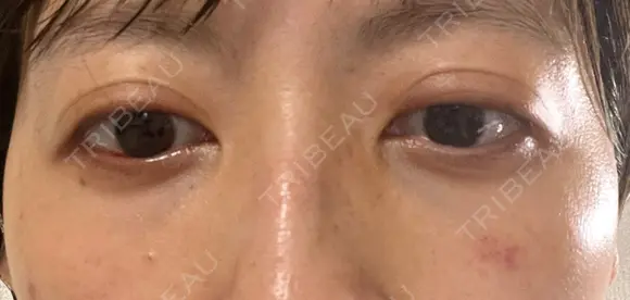 下まぶたの脂肪取り APOLLO BEAUTY CLINIC DAY 15 メイン用
