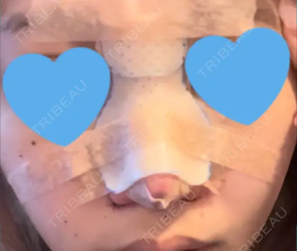 隆鼻術 / 鼻尖形成（切開） / 鼻中隔延長（切開） / 小鼻縮小（切開） / 軟骨移植 / 鼻尖縮小 R Beauty CLINIC 銀座院 DAY 1 メイン用