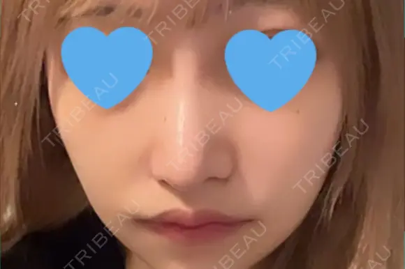 隆鼻術 / 鼻尖形成（切開） / 鼻中隔延長（切開） / 小鼻縮小（切開） / 軟骨移植 / 鼻尖縮小 R Beauty CLINIC 銀座院 DAY 8 メイン用