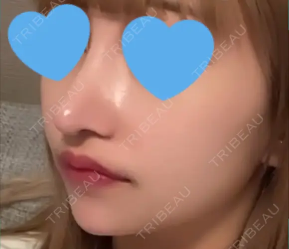 隆鼻術 / 鼻尖形成（切開） / 鼻中隔延長（切開） / 小鼻縮小（切開） / 軟骨移植 / 鼻尖縮小 R Beauty CLINIC 銀座院 DAY 9 メイン用