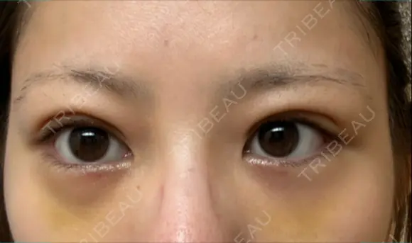 下まぶたの脂肪取り APOLLO BEAUTY CLINIC DAY 7 メイン用